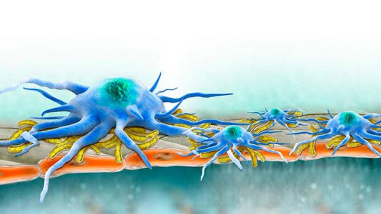 Colorful illustration showing how fibrosis, or a spiky lumpy mass of scar tissue, forms over healthy liver tissue when the liver attempts to repair and replace damaged cells