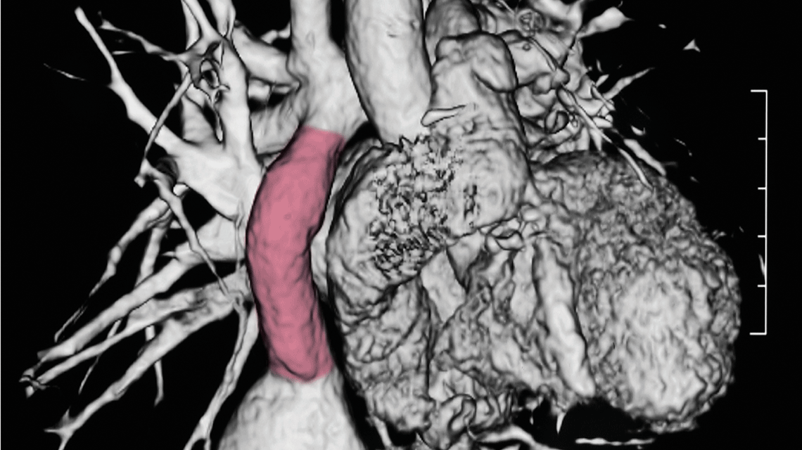 image of heart with fontan conduit highlighted