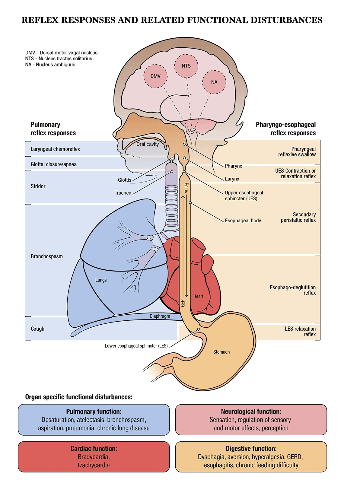 Acid reflux in premature infants