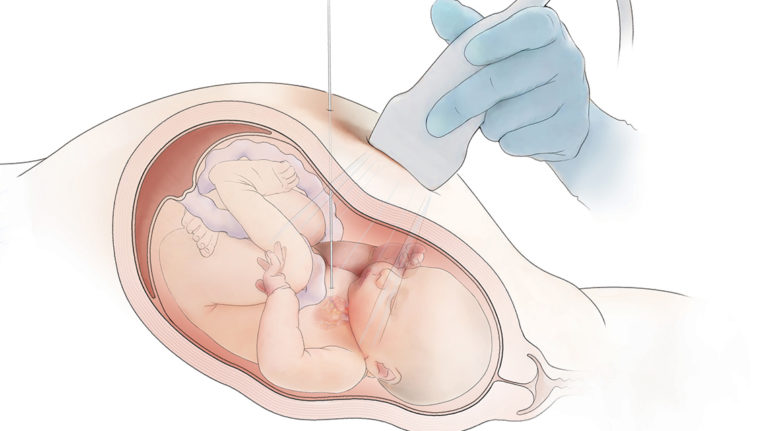 Fetus in utero receiving valvuloplasty