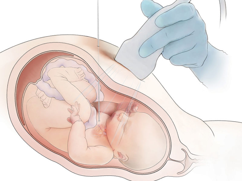Fetus in utero receiving valvuloplasty