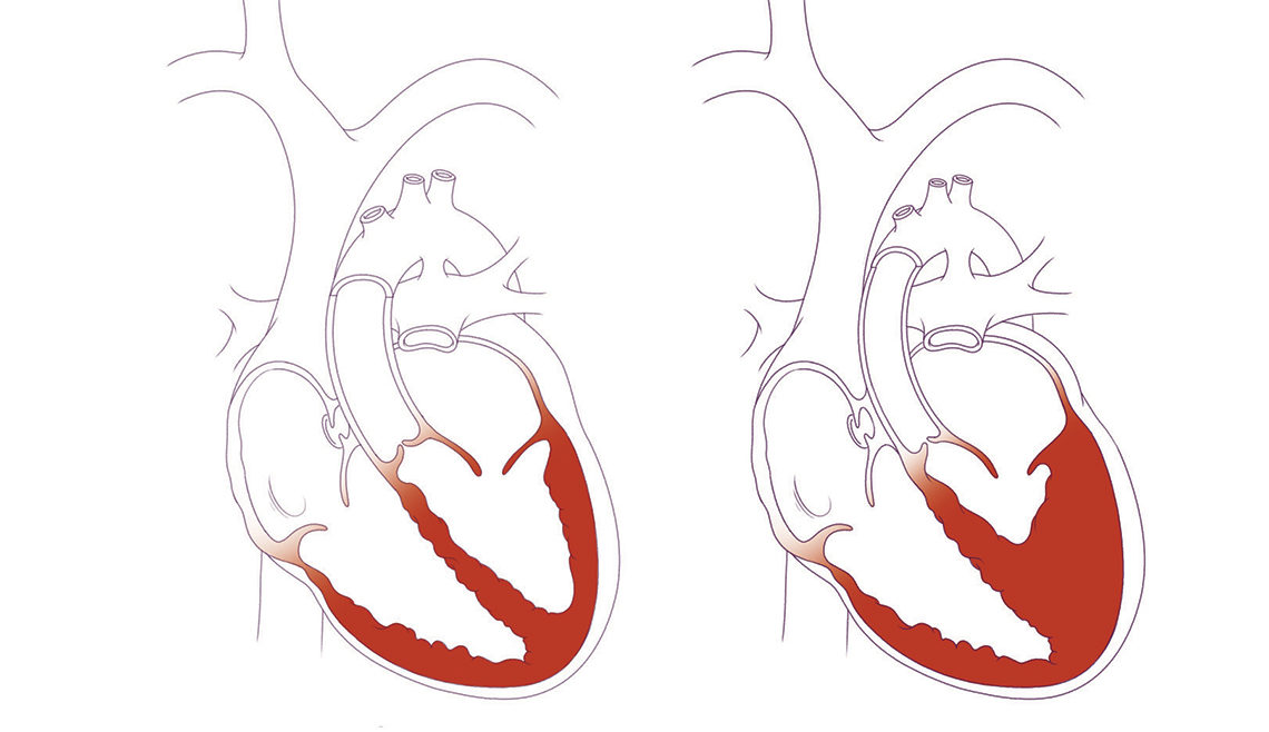 Heart with HLHS compared to typically developed heart