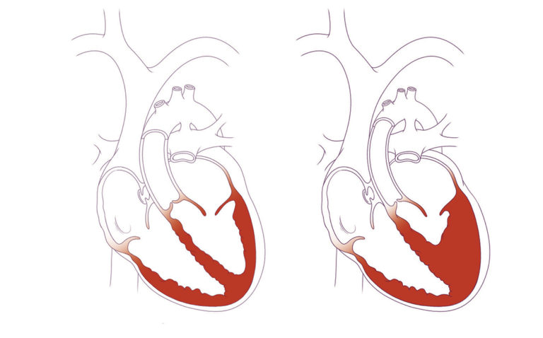 Heart with HLHS compared to typically developed heart