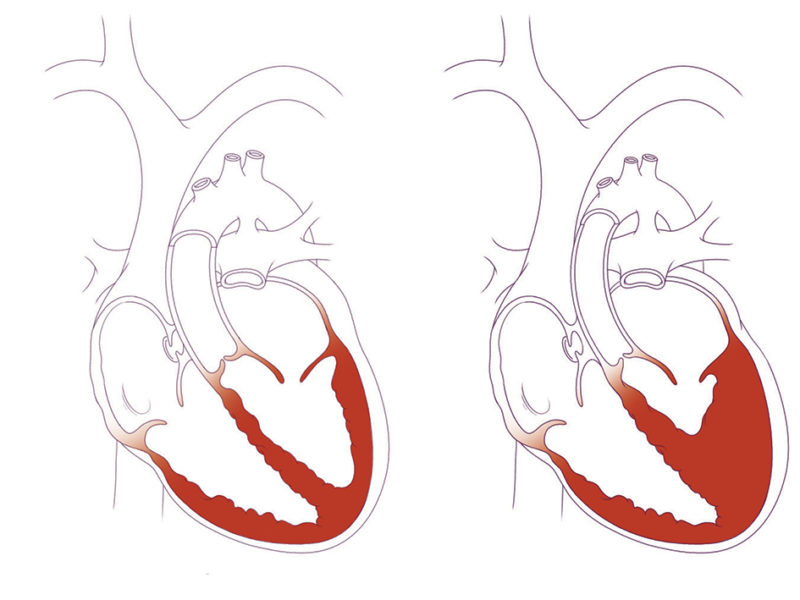 Heart with HLHS compared to typically developed heart