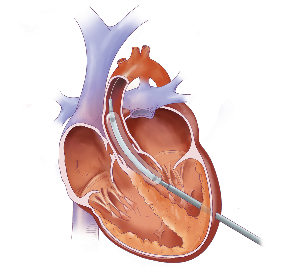 Heart cross section with balloon catheter