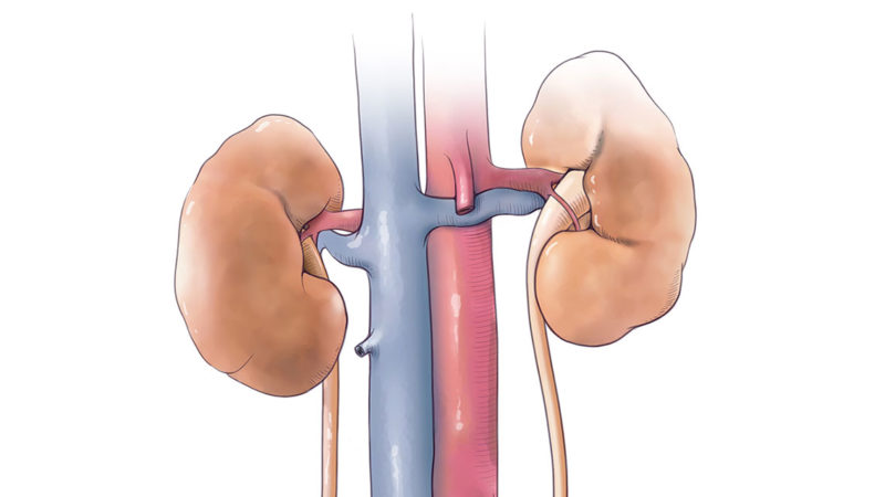 Keeping Options Open In Complex Pediatric Nephrolithiasis Pediatrics