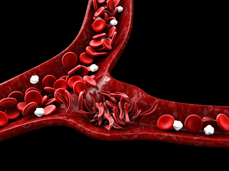 A close-up medical illustration of blood vessels showing normal round red blood cells flowing through the vessel, with a cluster of rigid, crescent-shaped sickle cells causing a blockage. White blood cells are also visible against the dark background.