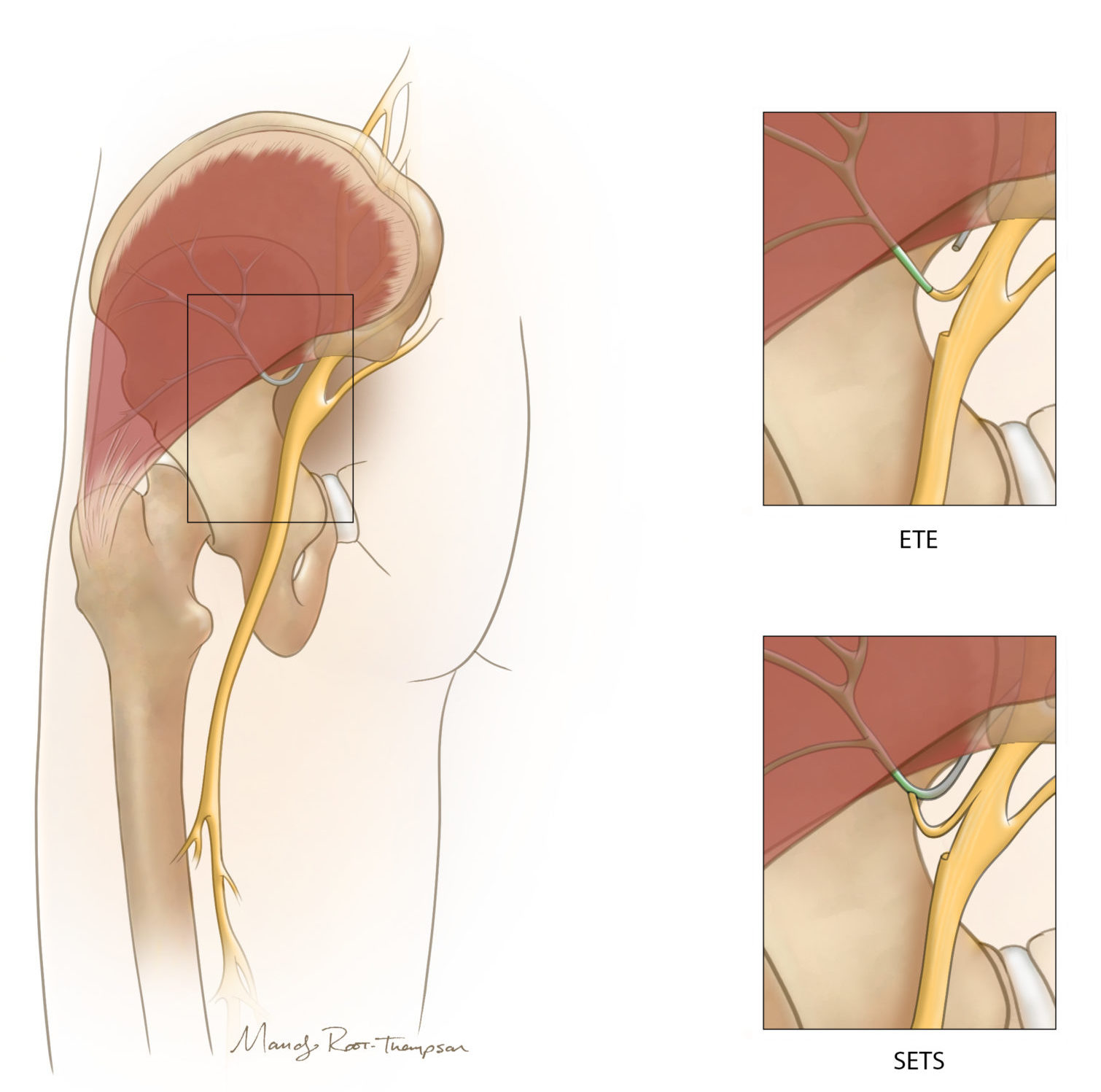 Medical illustration of nerve transfer