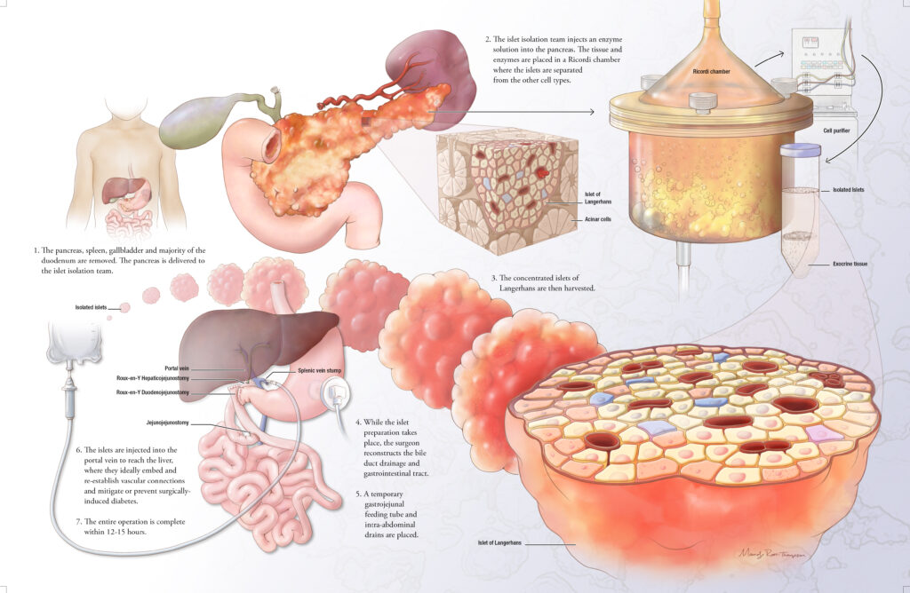 InSight: Total Pancreatectomy With Islet Autotranplantation: The Basics ...