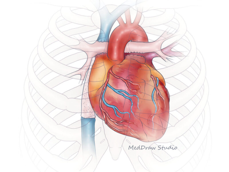 Illustration of a heart showing the Fontan surgery