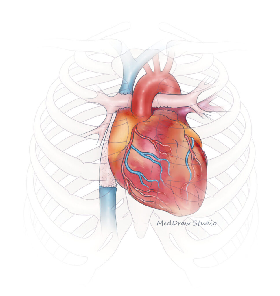 Illustration of a heart showing the Fontan surgery