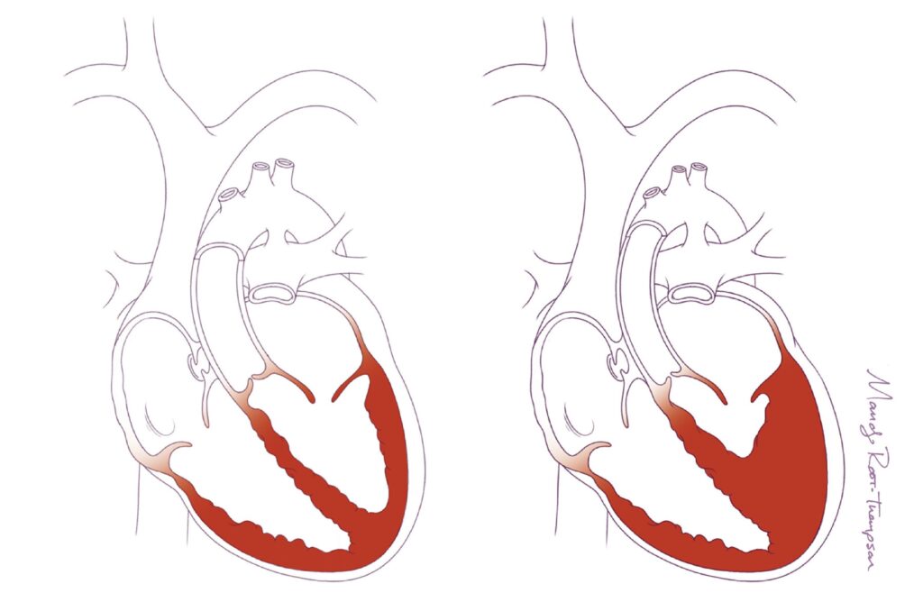 Right and Left heart Chambers