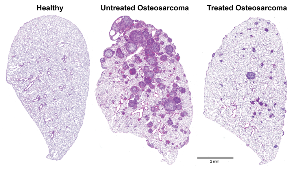 Microscope images of lung from mice with healthy lungs, mice with osteosarcoma bone tumors metastasized to the lungs, and mice with osteosarcoma that were treated with a drug that prevents scar formation in the lung.