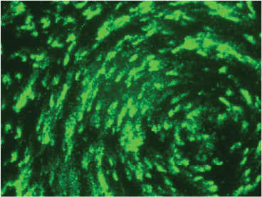 Microscopy image of human bronchial epithelial cells in culture 48 hours after inoculation with RSV that expresses green fluorescent protein. The image shows the distribution of virus through the cell culture.