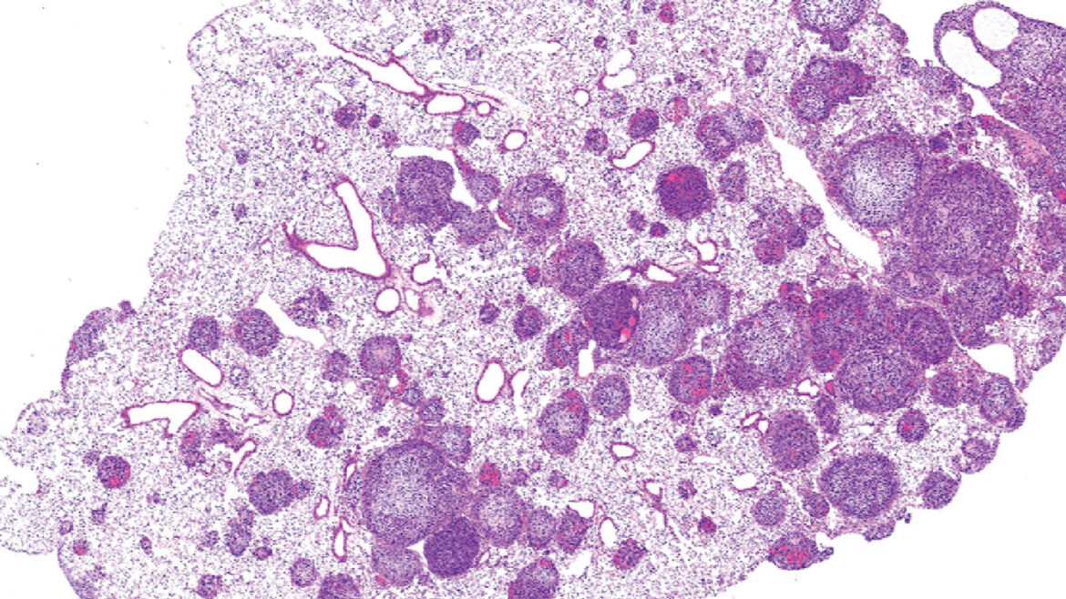 cropped microscopy image of lungs tissue with tumors