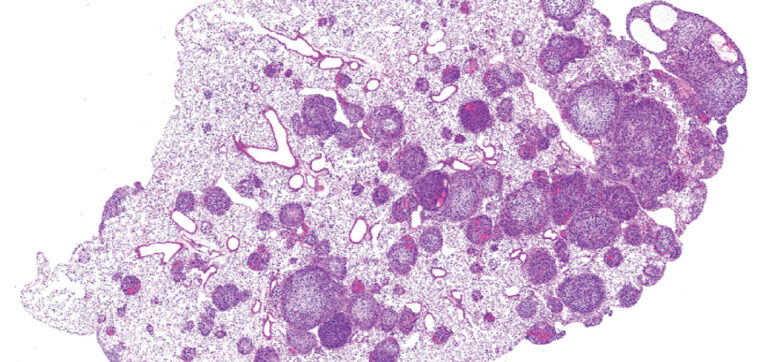 cropped microscopy image of lungs tissue with tumors
