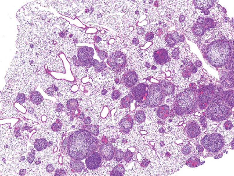 cropped microscopy image of lungs tissue with tumors