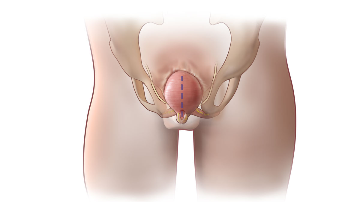 medical illustration showing male patient post-primary closure for bladder exstrophy