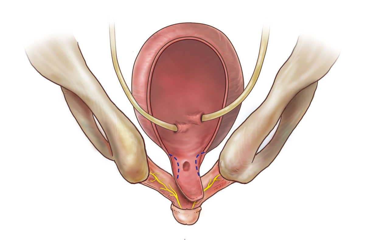 medical illustration showing placement of ureters in open bladder