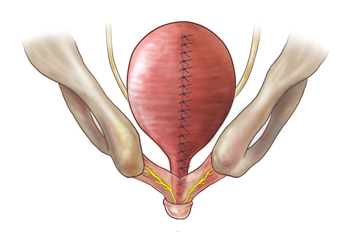 medical illustration of bladder neck reconstruction