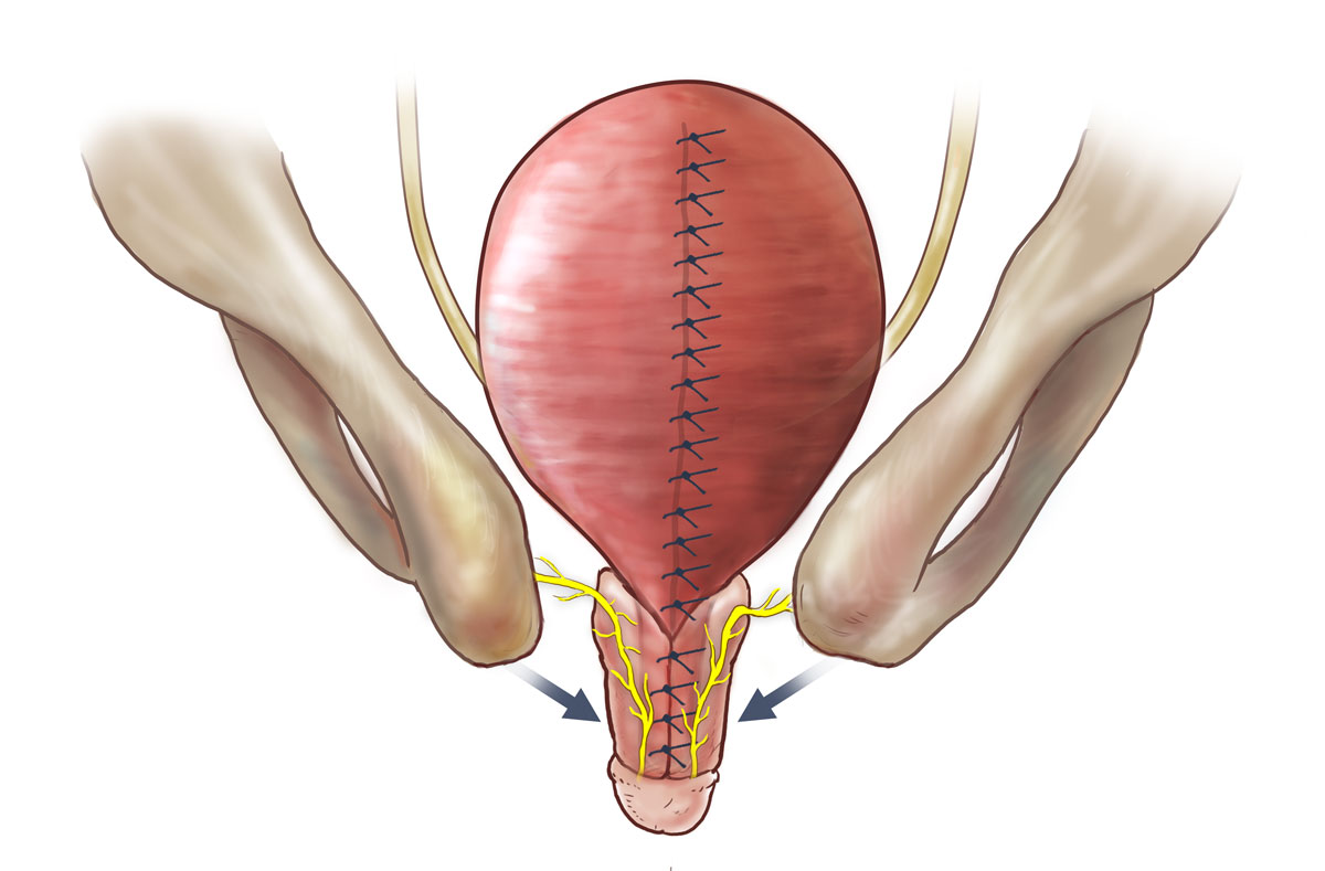medical illustration showing penile reconstruction