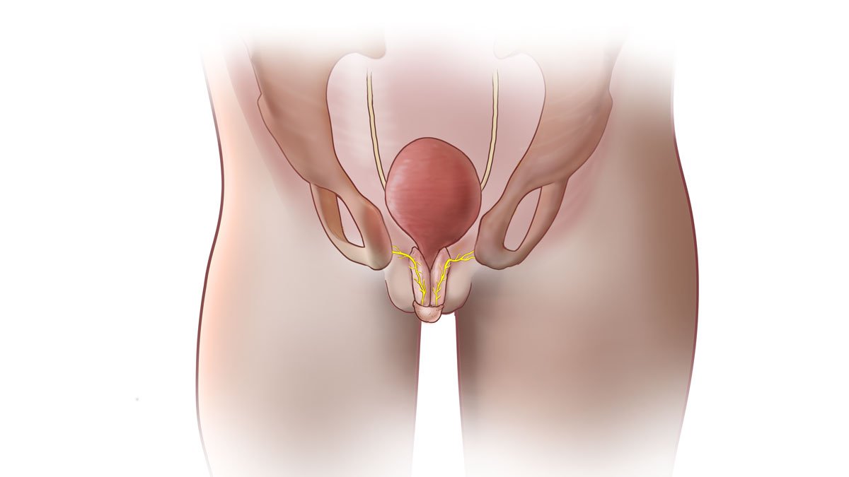 postoperative anatomy following Kelly procedure