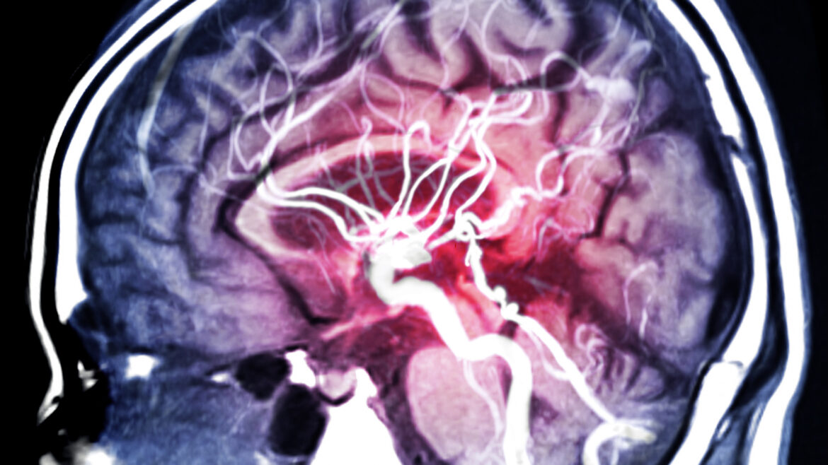 MRA Brain or Magnetic resonance angiography (MRI) of Vessel in the brain sagittal view for evaluate them stenosis
