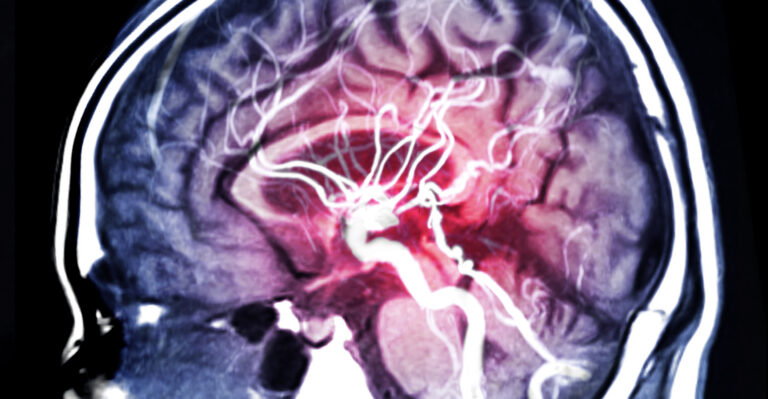 MRA Brain or Magnetic resonance angiography (MRI) of Vessel in the brain sagittal view for evaluate them stenosis