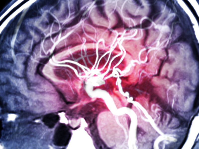 MRA Brain or Magnetic resonance angiography (MRI) of Vessel in the brain sagittal view for evaluate them stenosis