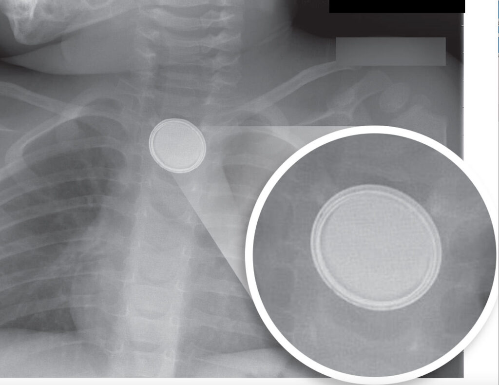 X-ray image showing a button battery lodged in a child's throat, with a callout showing a close up of the battery, highlighting the double ring around it