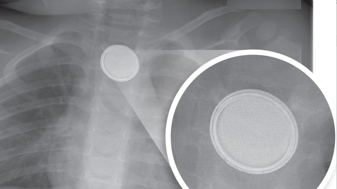 X-ray image showing a button battery lodged in a child's throat, with a callout showing a close up of the battery, highlighting the double ring around it