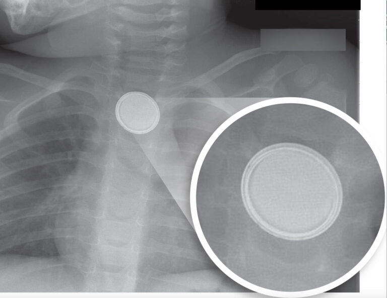 X-ray image showing a button battery lodged in a child's throat, with a callout showing a close up of the battery, highlighting the double ring around it
