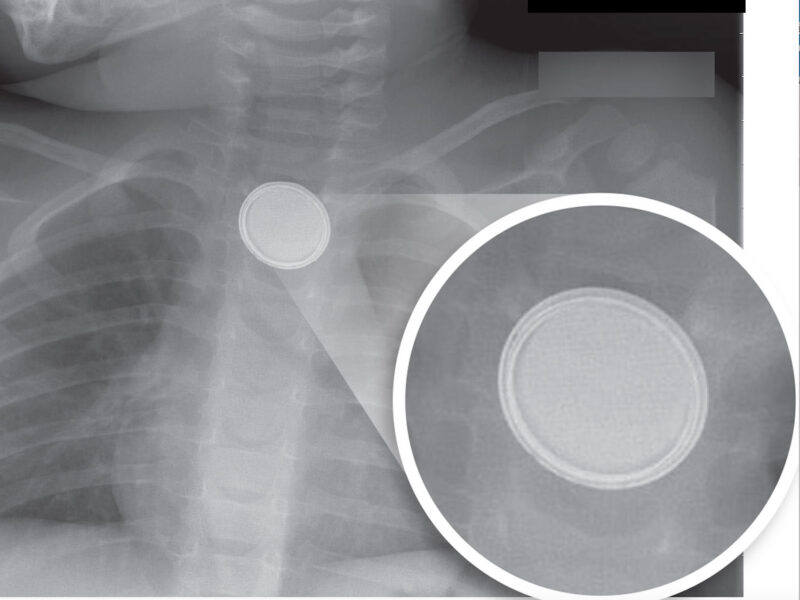X-ray image showing a button battery lodged in a child's throat, with a callout showing a close up of the battery, highlighting the double ring around it