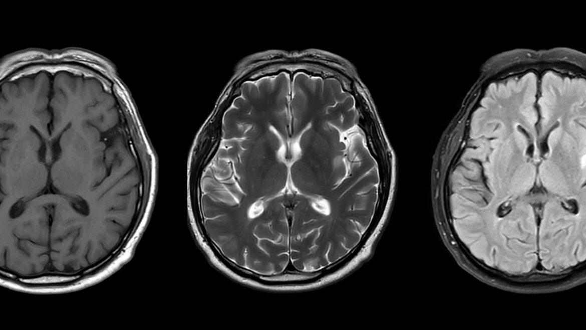 MRI scans of a brain