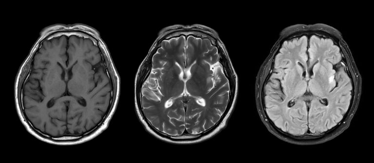 MRI scans of a brain