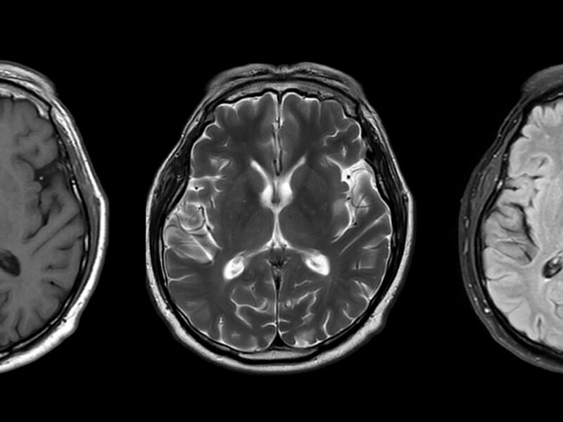 MRI scans of a brain