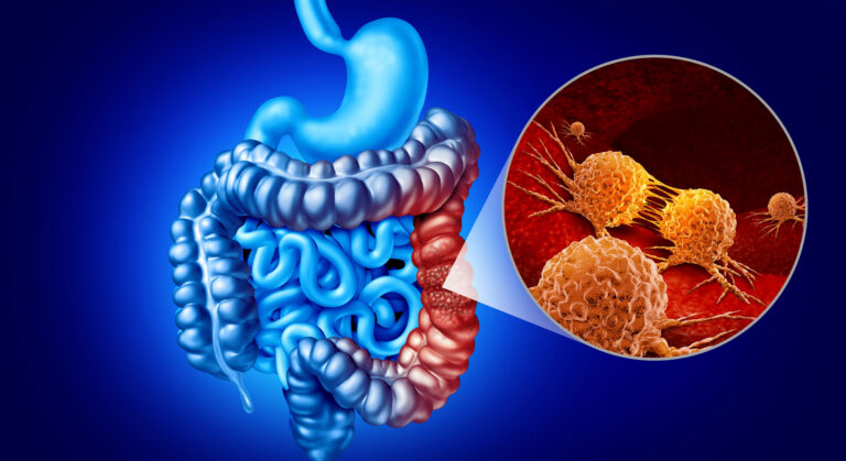 Medical illustration of the digestive tract with a section of the colon highlighted in red and a magnified inset depicting cancer cells.