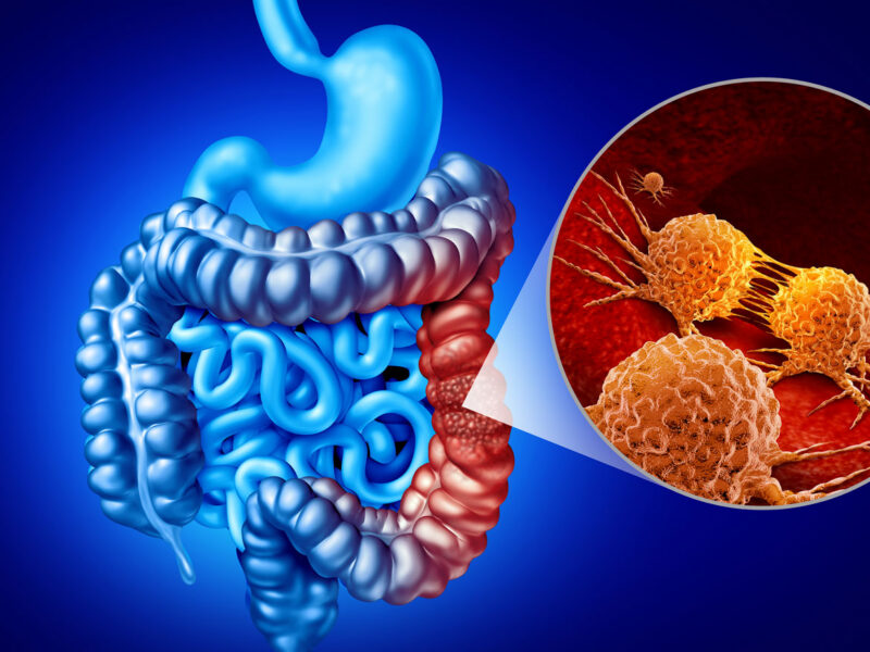 Medical illustration of the digestive tract with a section of the colon highlighted in red and a magnified inset depicting cancer cells.